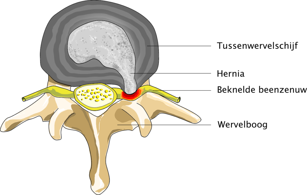 Nekhernia – Niekvanberlo