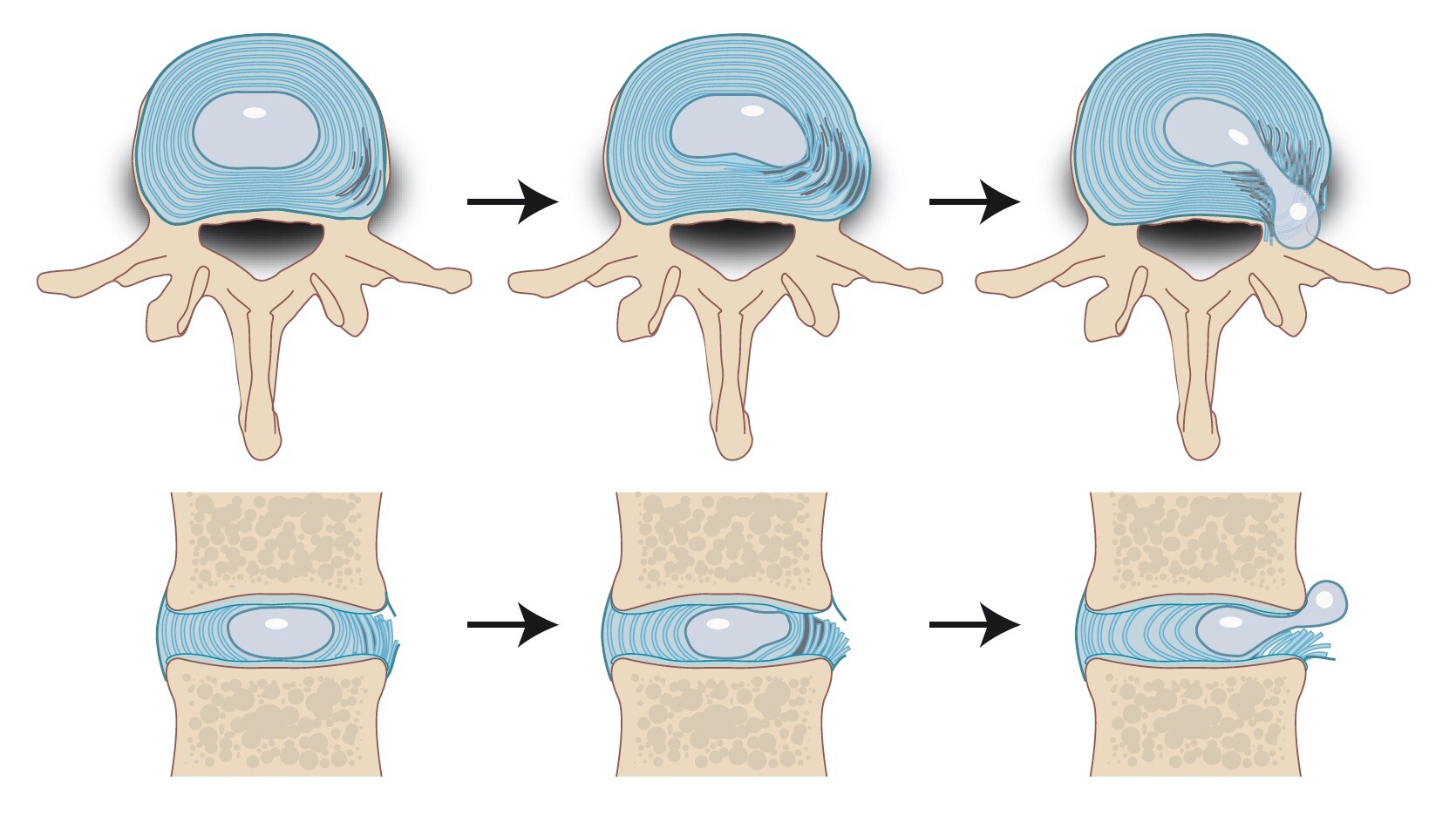 Hernia – Niekvanberlo